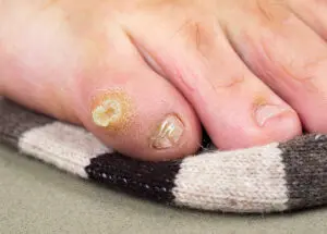 Callus on a foot 
