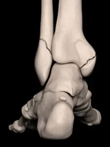 Digital illustration of broken ankle