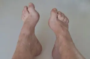 Foot with high arches and hammertoes