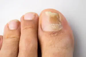 Fungal infection on big toenail