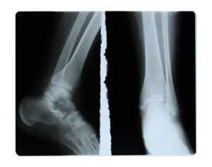 Foot fingers exposed on x-ray black and white film