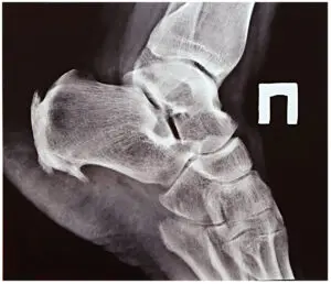 X-ray of heel spur on foot
