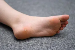 Plantar wart on foot