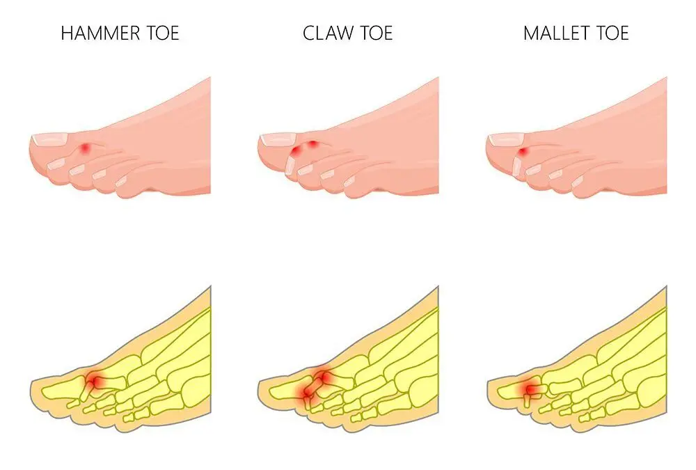 Hammertoe