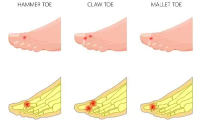 Hammertoe