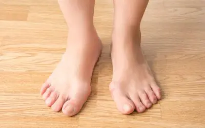 Bunions