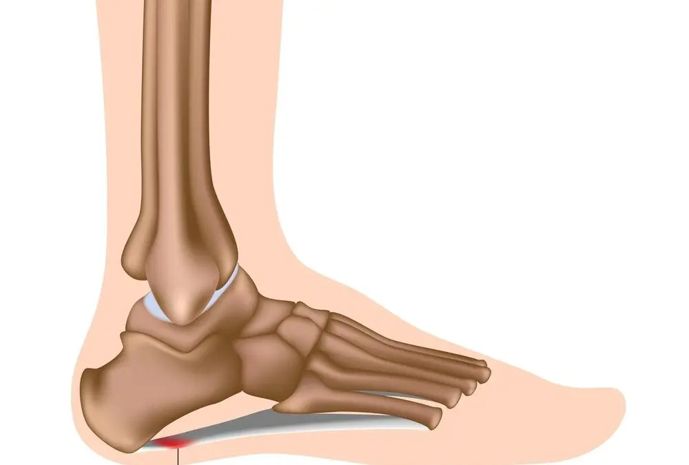 Plantar Fascitis