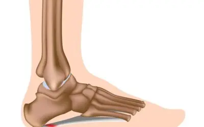 Plantar Fascitis