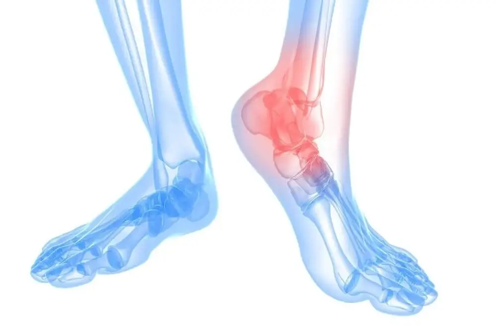 Arthritis