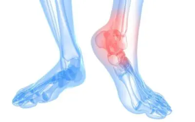 Arthritis