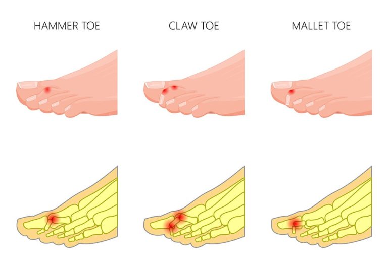 Illustration of the differences between hammer toe, claw toe, mallet toe