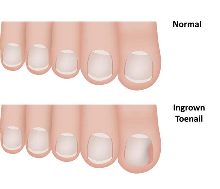illustration of normal toe nails versus ingrown toe nails