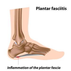 Illustration of a foot with Plantar fasciitis
