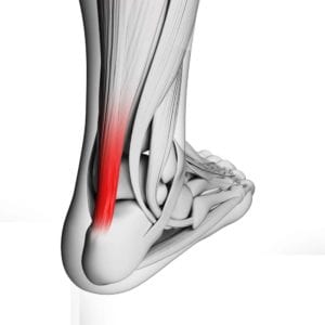 Illustration of achilles tendon pain