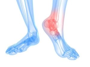 X-ray style illustration showing ankle pain