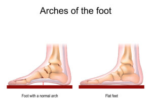 Arches of the foot chart
