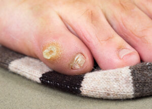 Callus on a foot 