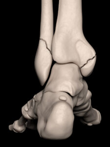 Digital illustration of broken ankle