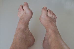 Foot with high arches and hammertoes