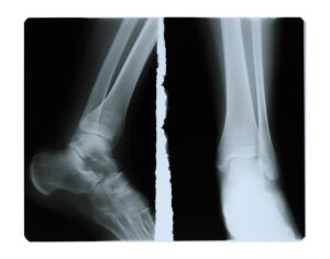 Foot fingers exposed on x-ray black and white film