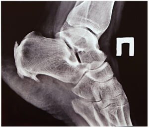 X-ray of heel spur on foot
