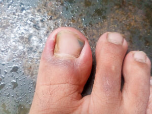 Ingrown big toenail