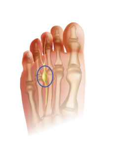 Diagram of a Morton's Neuroma with a blue circle around the neuroma