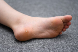 Plantar wart on foot