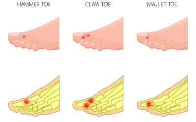 Hammertoe