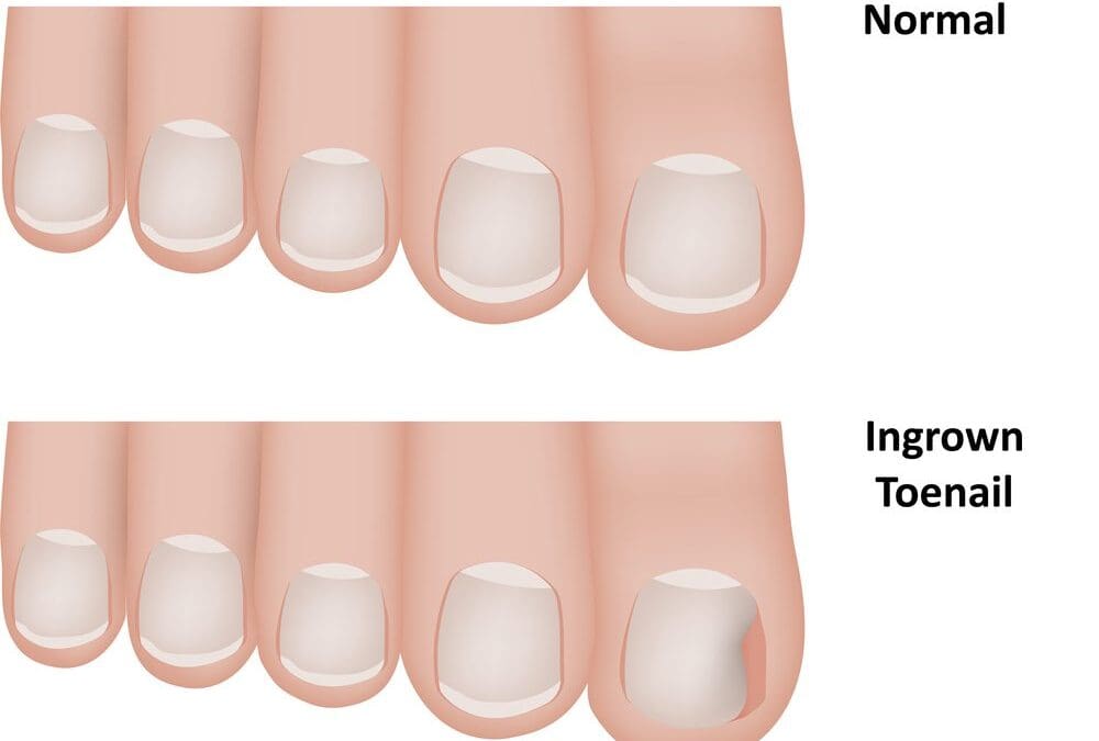 Ingrown Toenail