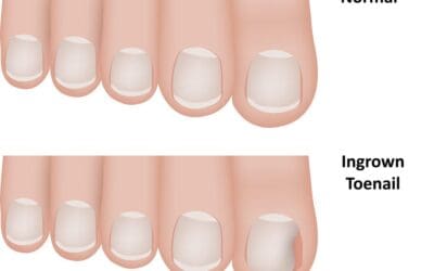 Ingrown Toenail
