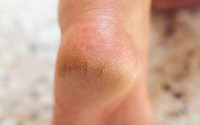 Dry, Cracked Feet and Heel Fissures