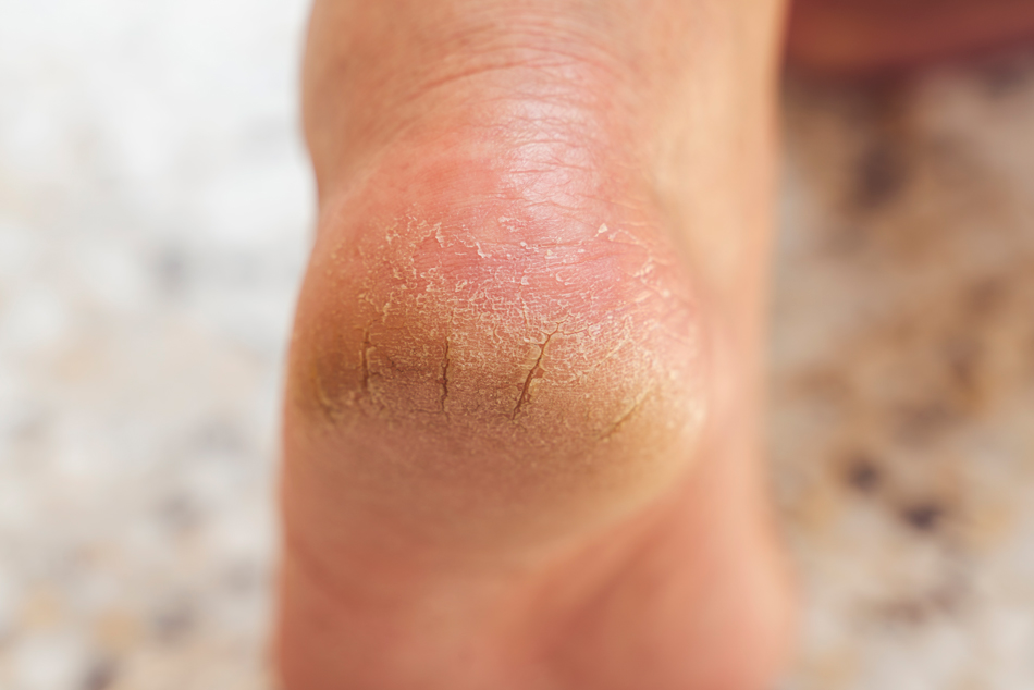The heel of foot with bad skin is covered with cracks